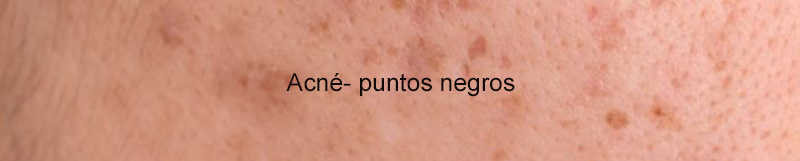 Acné/ puntos negros